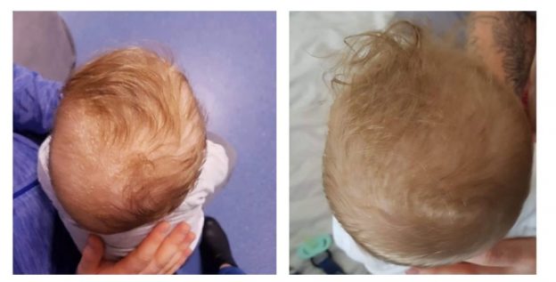 Plagiocephaly Before and After Treatment Pictures